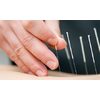 $29 for Three Acupuncture Treatments ($66 Value)